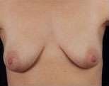 Mastopexy