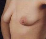 Mastopexy