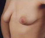 Mastopexy