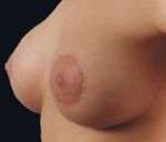 Mastopexy