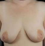 Mastopexy