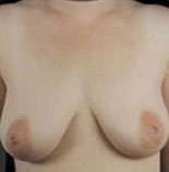 Mastopexy
