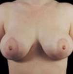 Mastopexy