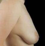 Mastopexy