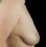 Mastopexy