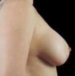 Mastopexy