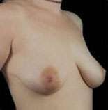 Mastopexy