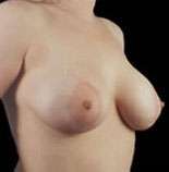Mastopexy