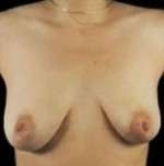 Mastopexy