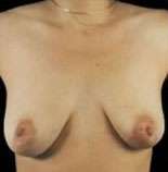 Mastopexy