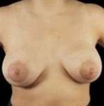 Mastopexy