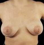 Mastopexy