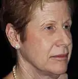 Facelift