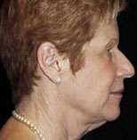 Facelift