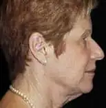 Facelift