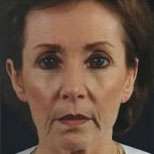 Facelift