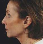 Facelift