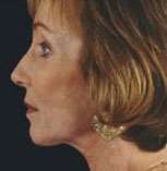 Facelift