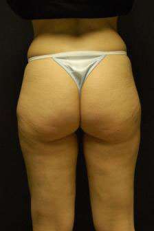 Liposculpture (Female)