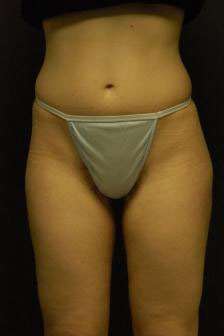Liposculpture (Female)