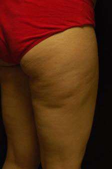 Liposculpture (Female)
