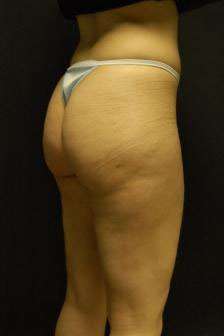 Liposculpture (Female)