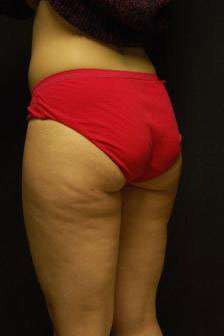 Liposculpture (Female)