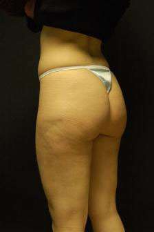 Liposculpture (Female)