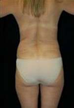Liposculpture (Female)