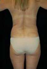 Liposculpture (Female)