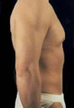 Liposculpture (Male)