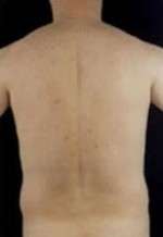 Liposculpture (Male)