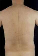 Liposculpture (Male)