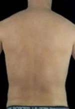 Liposculpture (Male)