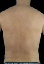 Liposculpture (Male)