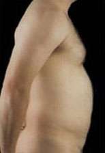 Liposculpture (Male)