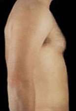 Liposculpture (Male)