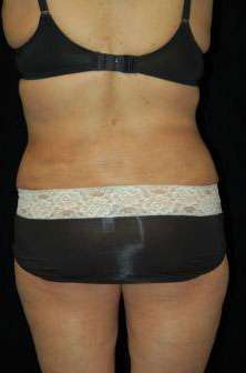 Smartlipo Triplex Laser Liposuction