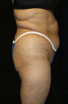 Smartlipo Triplex Laser Liposuction