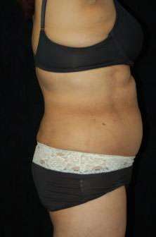 Smartlipo Triplex Laser Liposuction