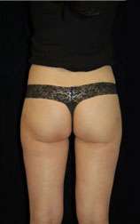 Smartlipo Triplex Laser Liposuction