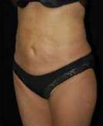 Smartlipo Triplex Laser Liposuction