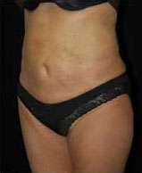 Smartlipo Triplex Laser Liposuction