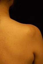 Minimal Incision and Power-assisted Liposuction Removal of Lipomas