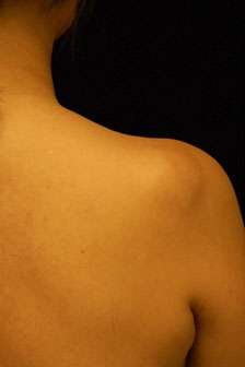 Minimal Incision and Power-assisted Liposuction Removal of Lipomas