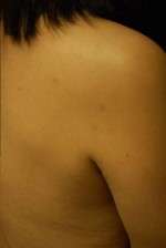 Minimal Incision and Power-assisted Liposuction Removal of Lipomas