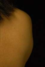 Minimal Incision and Power-assisted Liposuction Removal of Lipomas