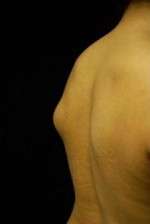 Minimal Incision and Power-assisted Liposuction Removal of Lipomas