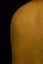Minimal Incision and Power-assisted Liposuction Removal of Lipomas