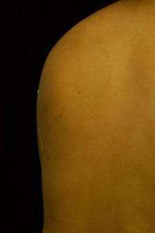 Minimal Incision and Power-assisted Liposuction Removal of Lipomas